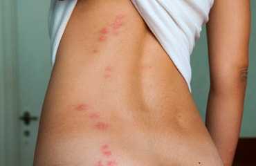 Bedbug Control